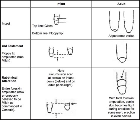 Circumcised vs. Uncircumcised: Whats the。